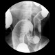 Ulcerative colitis, barium enema, irrigography: RF - Fluoroscopy